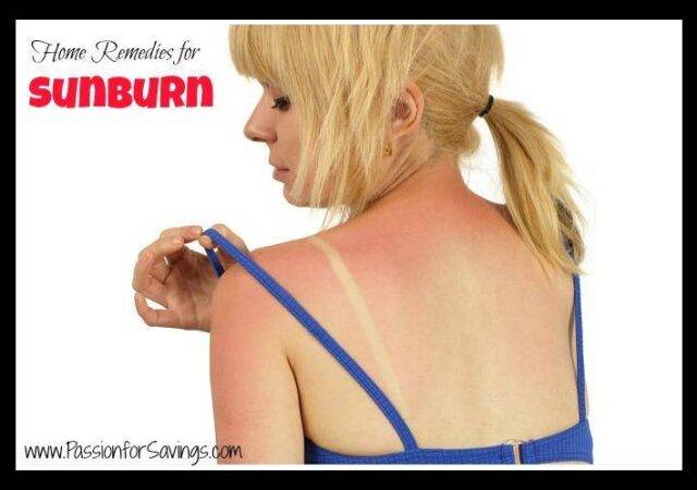 How Remedies for Sun Burn
